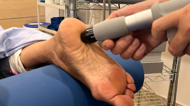 Ondas de choque para la fascitis plantar