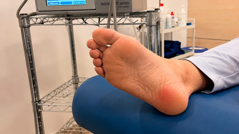 ¿Dónde duele la fascitis plantar?
